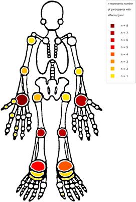 Clinical Features of HIV Arthropathy in Children: A Case Series and Literature Review